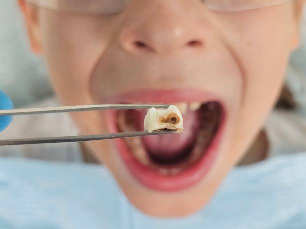 Best Broken or Chipped Tooth Repair in Montz, LA